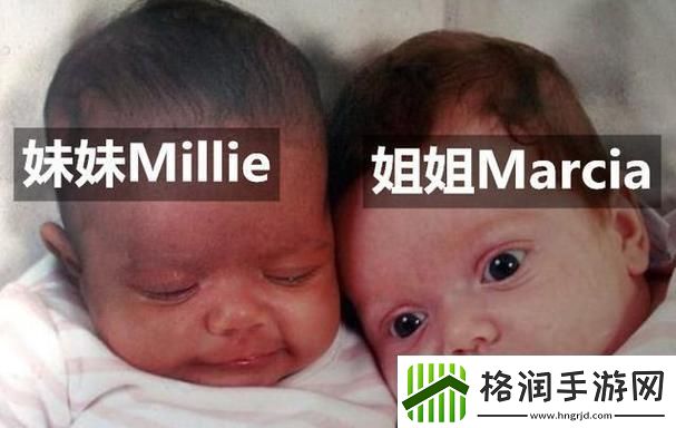 双胞胎“夹心”奇观