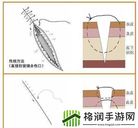 竹板打肿臂缝合不上