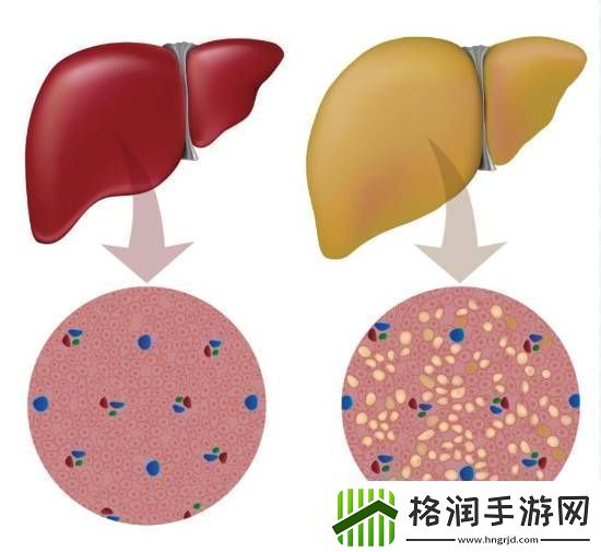 大学生月瘦20斤却患上脂肪肝