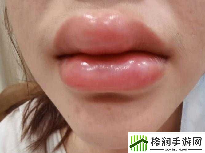 上下两张嘴都肿了