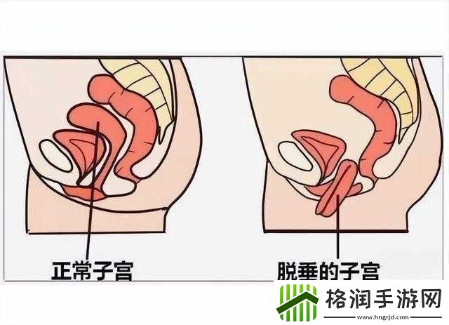 女性得阴挺病是怎么回事