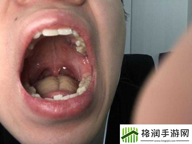 舌头舔到硬包疼痛难忍