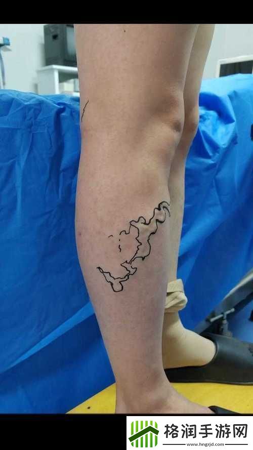 竹板打肿臂缝合不上